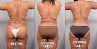 How Long To Recover From Liposuction 10 Liposuction Before And After Liposuction Plastic Surgery Surgery