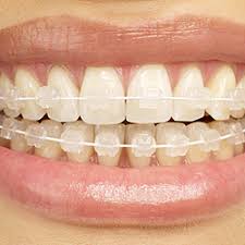 Praxis für Kieferorthopädie, Wortberg Weckelmann, Warendorf, Ennigerloh -  Lingualtherapie