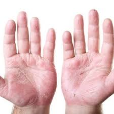 Untuk mengatasi kulit kering karena penggunaan hand sanitizer dan sabun cuci tangan, kamu bisa melakukan beberapa hal berikut ini. 7 Penyebab Kulit Telapak Tangan Mengelupas Dan Cara Atasinya
