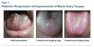 Image result for black tongue symptoms