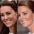 Botox Crows Feet Bags Under Eyes