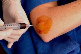 Image result for Elbow Injection
