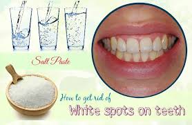 How to get rid of white spots on teeth at home. How To Get Rid Of White Spots On Teeth Overnight Teethwalls