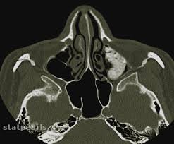 Image result for Sinus CT