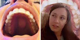 There are a lot of different causes for a bump on the roof of your mouth. A Small Percentage Of People Have A Bump On The Roof Of Their Mouths