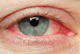 Red Itchy And Watery Eyes Oh My
