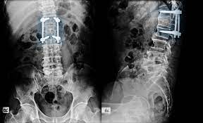 Stem Cell Chicago Stem Cell Therapy In Degenerative Disc Disease