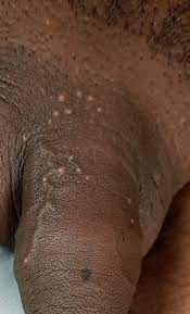 But after a few days now, and some sexual activities like fellatio etc., it has grown bigger and a white head is on it. Ingrown Hair On Penile Shaft Treatment