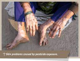 A study on the effects of deet insect repellent found that its daily use was not associated with an with pest control, it is important to balance the risks of pesticide exposure with the risk. Agricultural Pesticides And Human Health