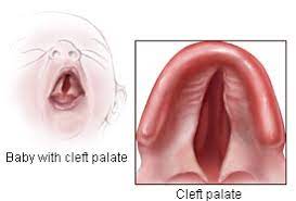 Facts About Cleft Lip And Cleft Palate Cdc