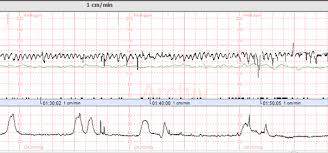 Bei meiner grossen gabs das erste ctg in der 21.ssw und bei der kleinen in der 19.ssw. Https Www Obsgyn Wiki Ch Geburtszentrum Fachliche Weisungen Ctg Beurteilung