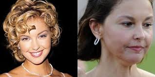 The before and afters show major signs of the swelling and that she must have actually gone through some pain on top of the embarrassment which obviously soon followed once she made her post surgery public debut. Ashley Judd S Face Changes Due To Botox Injections