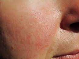 How To Get Rid Of Skin Conditions That Aren't Acne