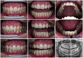 Send thanks to the doctor. Should I Bother To Fix Overbite I Have To Decide Whether I Ll Wear Braces Or Not My Smile Is Fine It Would Be Nice To Change Some Teeth Unaligment And Doctor Said