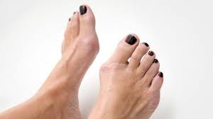 Bei einem spezialisten, das ist wirklich wichtig, dass du einen profi da ranlässt. Hallux Valgus Was Hilft Bei Einem Ballenzeh Ndr De Ratgeber Gesundheit