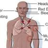 In the early course of the disease, clinical diagnosis of mvd is difficult to distinguish from other tropical febrile illnesses, because of. Https Encrypted Tbn0 Gstatic Com Images Q Tbn And9gcsh0vrf Eurlkbyllcj0 Gqpgpzucjpbne5jkvwgnlve9hhhowg Usqp Cau