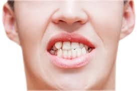 The best way on how you can fix crooked teeth without braces is by getting retainers or investing in the new and upcoming invisalign clear aligners. Crooked Teeth Causes Impact And Treatment