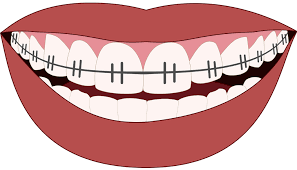 It's pretty easy and useful. 5 Tips For Surviving Your First Week With Braces Overby Orthodontics