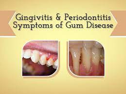 The Longer Plaque And Tartar Are On Teeth The More Harmful They Become The Bacteria Cause Inflammation Of The Gums T Gum Disease Periodontitis Receeding Gums