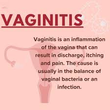 Image result for Vaginitis