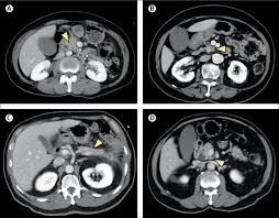 I had iv contrast but not oral. Deep Learning To Distinguish Pancreatic Cancer Tissue From Non Cancerous Pancreatic Tissue A Retrospective Study With Cross Racial External Validation The Lancet Digital Health