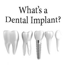 Although having your tooth pulled out may cost less initially, the space left will likely require an implant or bridge to be fitted, which can ultimately be drinking hot coffee immediately after a root canal treatment may increase sensitivity and cause discomfort in the. Dental Implant Recovery Time Tooth Implant Recovery Time