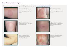Typically it may be seen in the groin, back, arms, thighs etc. Lyme Disease Uk Lyme Disease And The Em Rash