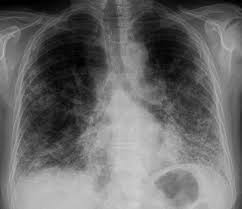 Pneumologie Unsere Krankheitsbilder Im Rontgenbild