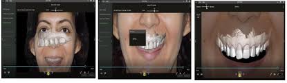 The Art of Dental Simulation Treatment Using the Artificial Intelligence