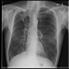 Aspergillosis is the name given to a wide variety of diseases caused by fungal infections from species of aspergillus. New Study Finds Invasive Aspergillosis Ia Affects Up To 2 Million People With Chronic Obstructive Pulmonary Disease Copd Globally Gaffi Gaffi Global Action Fund For Fungal Infections