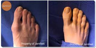 Los angeles foot and ankle specialist dr. Before After Bunion Surgery Photo Gallery Los Angeles Foot Doctor Beverly Hills