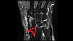 Image result for Scapholunate Dislocation