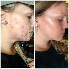 Taking accutane is a complicated process, with many milestones and controls along the way. Accutane For Adult Acne My Experience