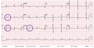 Image result for ST Elevation