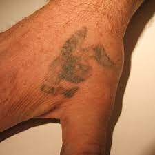 Prima pico series offers the most. Ink Blasters Precision Laser Tattoo Removal In Metro Detroit