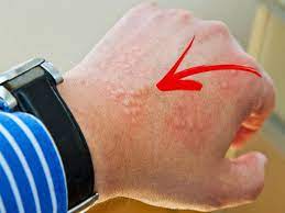 Skin cancer is one of the most common types of cancer. Basal Cell Carcinoma Symptoms Causes And Treatment à®‰à®™ à®• à®šà®° à®®à®¤ à®¤ à®² à®‡à®ª à®ªà®Ÿ à®‡à®° à®• à®• à®…à®ª à®ª à®…à®¤ à®‡à®¨ à®¤ à®ª à®± à®± à®¨ à®¯ à®© à®…à®± à®• à®± à®‰à®· à®° à®‡à®° à®™ à®• Tamil Boldsky