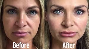 Even though cheek fillers aren't as common as, say, lip fillers, chances are you probably know someone who's gotten the procedure. Dermal Filler Cheek Restoration Restylane Defyne Youtube