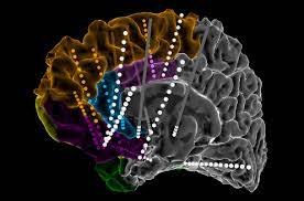 The Frontiers Of Neurology: Deep Brain Stimulation And Beyond