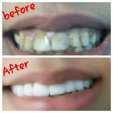 Smile Stardom Dental Clinic الدكتور احمد القطاع Posts Facebook