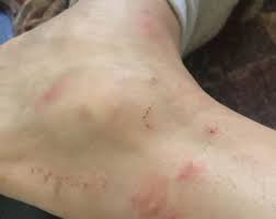 Pe corp apar mici eruptii cutanate, sub forma unor bubite rosii sau umflaturi. Aduce Vant La Timp Bubite Pe Picioare Butlercarriers Com