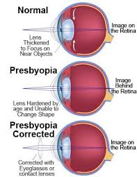 Eye Presbyopia Corrected Optometry School Optometry Eyes