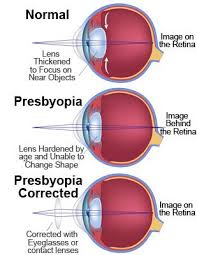 eye presbyopia corrected optometry school optometry eyes