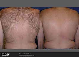 Hair removal barbers beauty salons. Hair Removal Advanced Cosmetic Surgery Greenville Sc