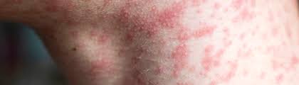 Image result for measles