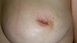 However, these signs and symptoms are most often associated with benign breast. 7 Pictures Of Breast Cancer