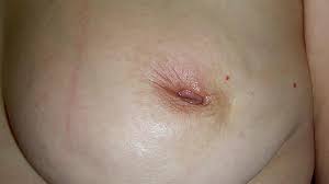 Inflammatory breast carcinoma is a rare type of invasive ductal carcinoma, which mimics an infection or mastitis at presentation. 7 Pictures Of Breast Cancer