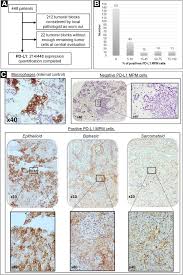 Most tumors arise from the pleura, and so this article will focus on pleural mesothelioma. Shorter Survival In Malignant Pleural Mesothelioma Patients With High Pd L1 Expression Associated With Sarcomatoid Or Biphasic Histology Subtype A Series Of 214 Cases From The Bio Maps Cohort Clinical Lung Cancer