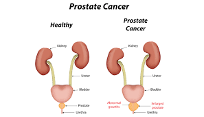 Prostate cancer normally causes no symptoms until the cancer has grown large enough to put pressure on the urethra. Prostate Cancer Symptoms Causes And Treatment Apollo Spectra