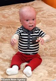 Harlequin ichthyosis is a rare, congenital skin condition. Housebound Boy Two Is Mistaken For A Doll Because Of A Rare Condition Express Digest