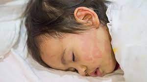 Treating Hives In Children Everyday Health
